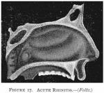 Figure 17. Acute Rhinitis.