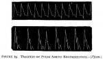 Figure 19. Tracings of Pulse Aortic Regurgitations...