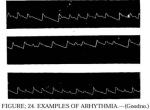 Figure 24. Examples of Arhythmia.