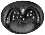 Figure 25. Chronic follicular pharyhgitis.
