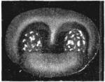 Figure 26. Follicular Tonsillitis.