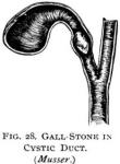 Figure 28. Gall-stone in cystic duct.