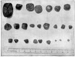 Figure 27. Gall-stones.