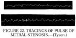 Figure 22. Tracings of pulse