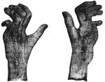 Figure 44. Two views of a hand