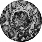 Figure 35. An atrophied glomerulus.