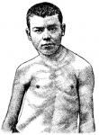 Figure 39. Poliomyelitis anterior
